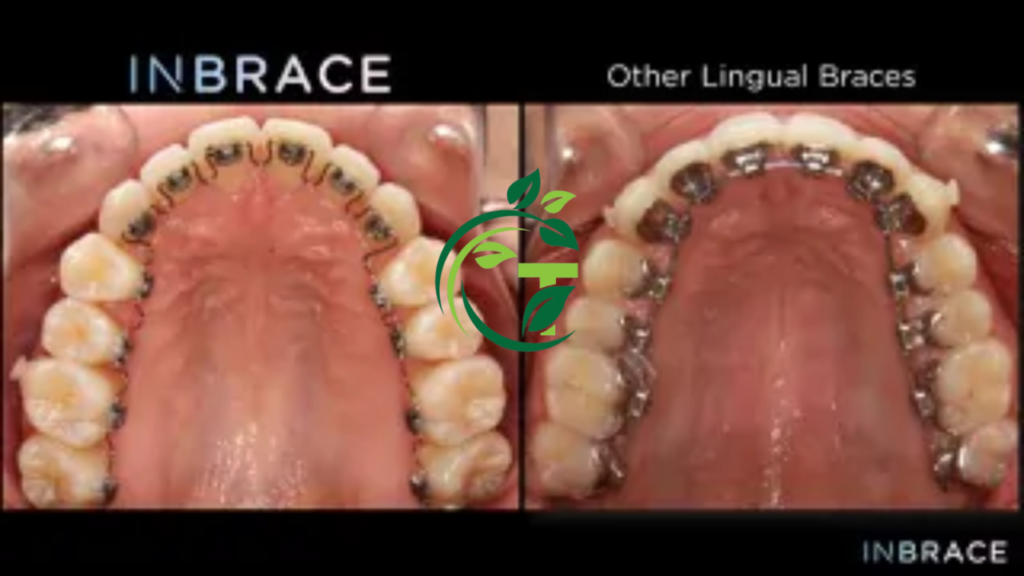 braces vs lingual braces