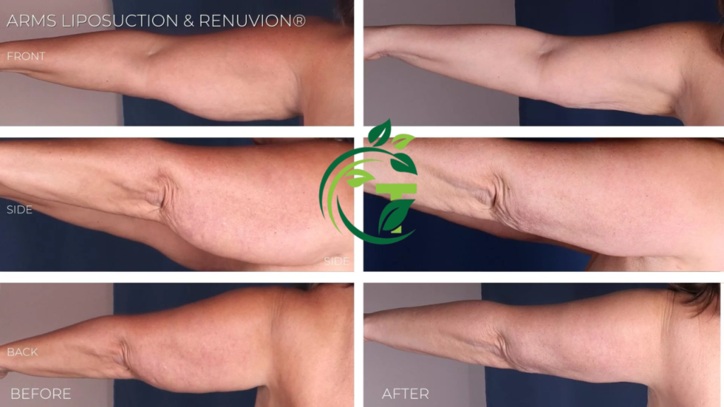 arm lipo cost